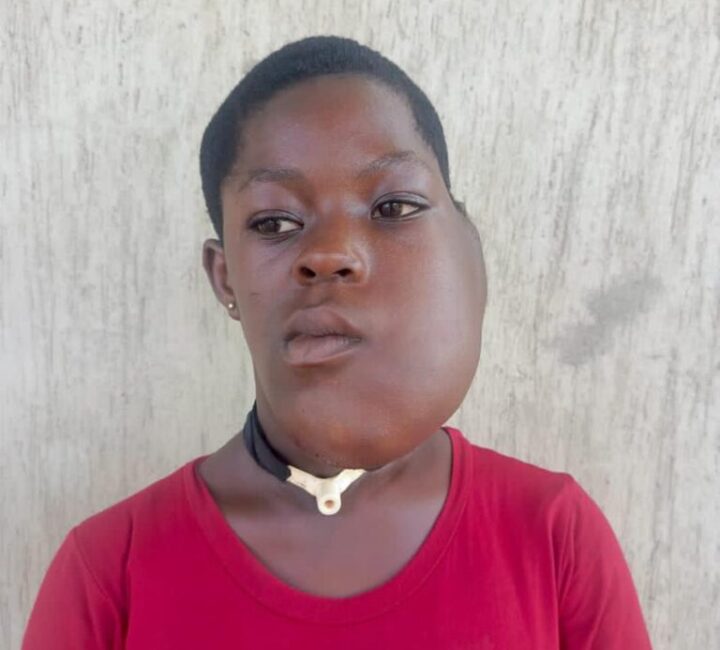 Kumasi. EKK Foundation Appeals For Support To Correct Tumor In 12 Year Old