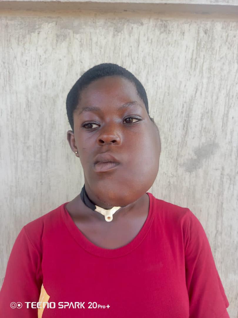 Kumasi. EKK Foundation Appeals For Support To Correct Tumor In 12 Year Old